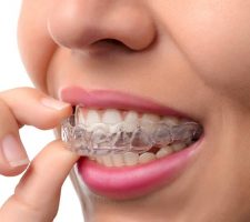 ¿Cuál es el mejor pegamento para acetato dental?