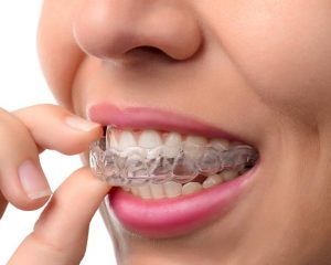 ¿Cuál es el mejor pegamento para acetato dental?